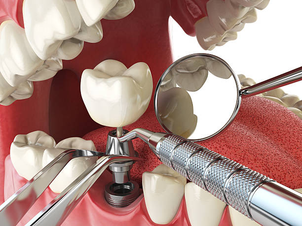 Best Emergency Root Canal Treatment in Gearhart, OR